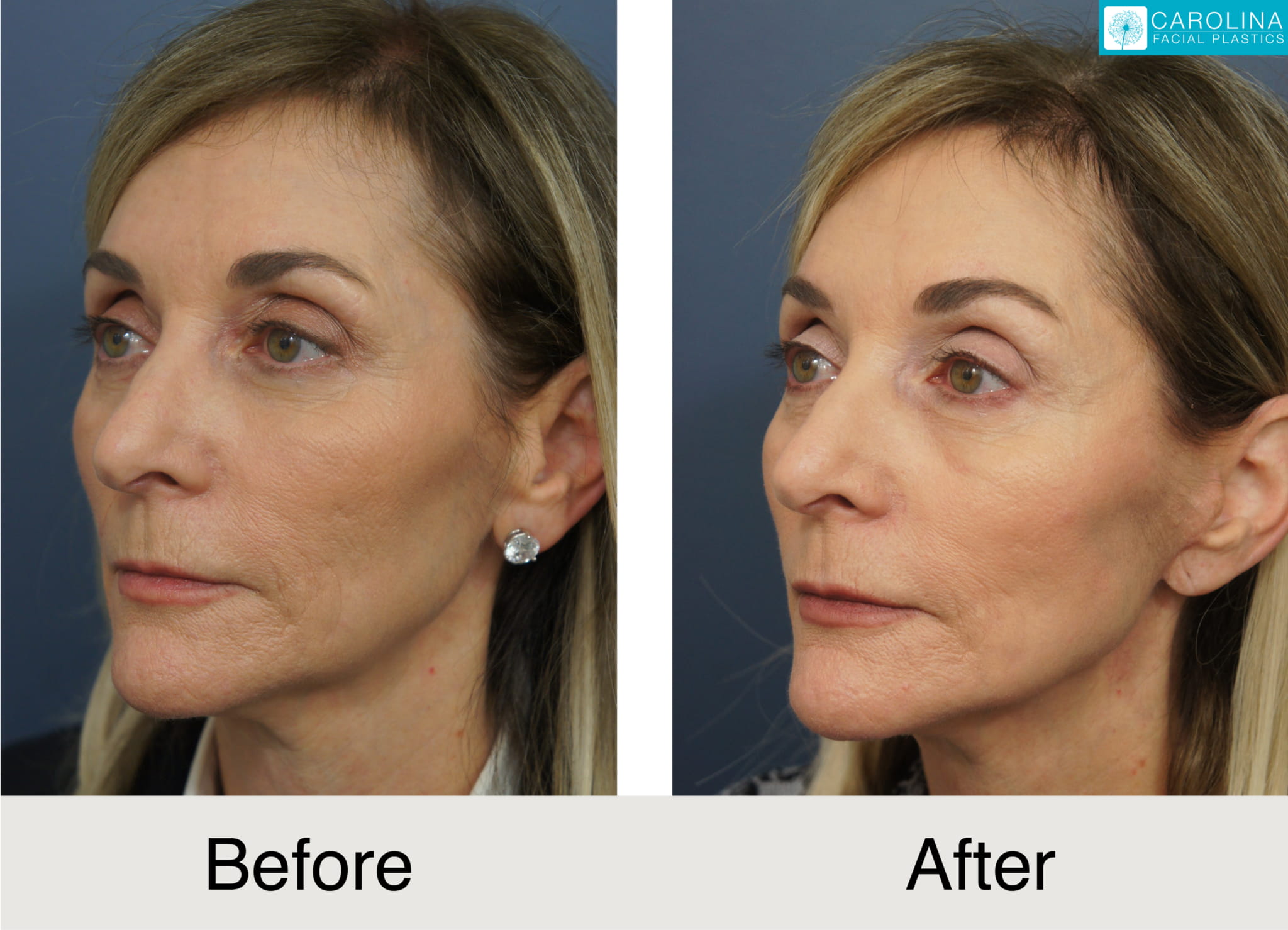 mini facelift before and after photos of a female patient
