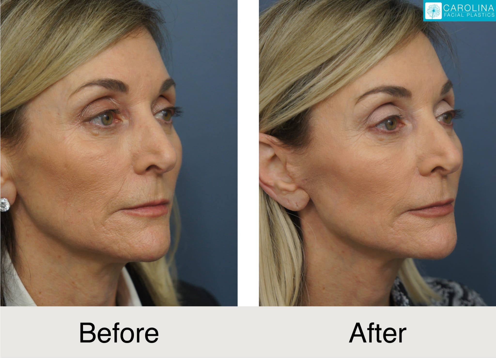 mini facelift before and after photos of a female patient