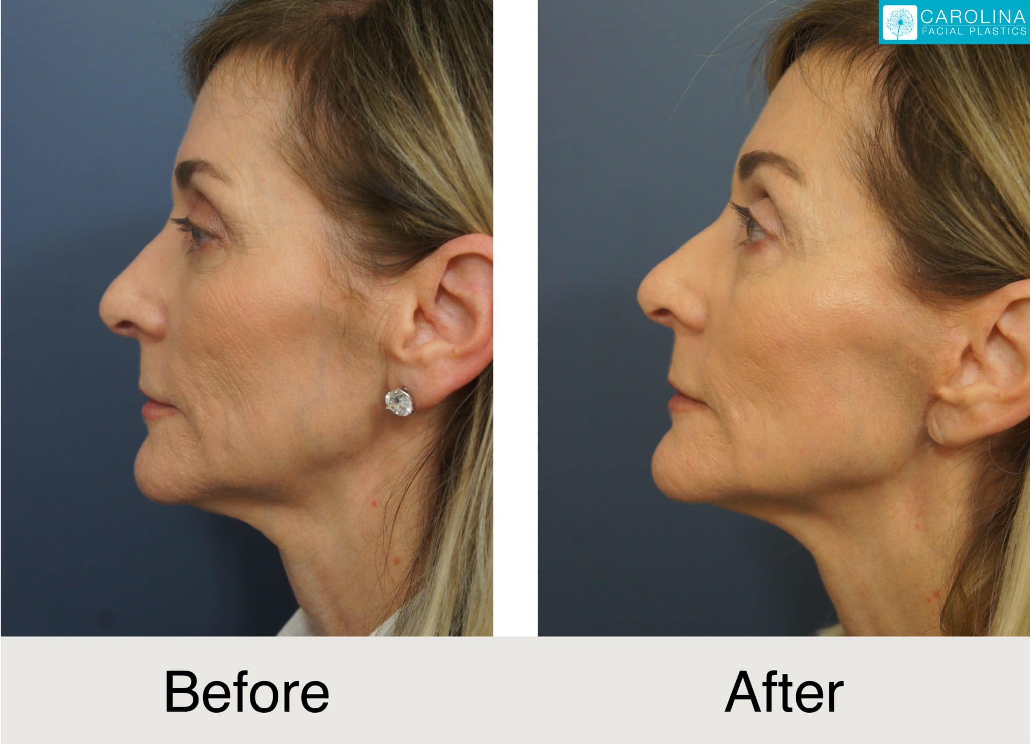 mini facelift before and after photos of a female patient