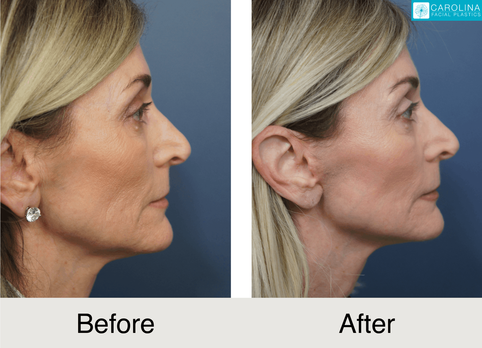 mini facelift before and after photos of a female patient