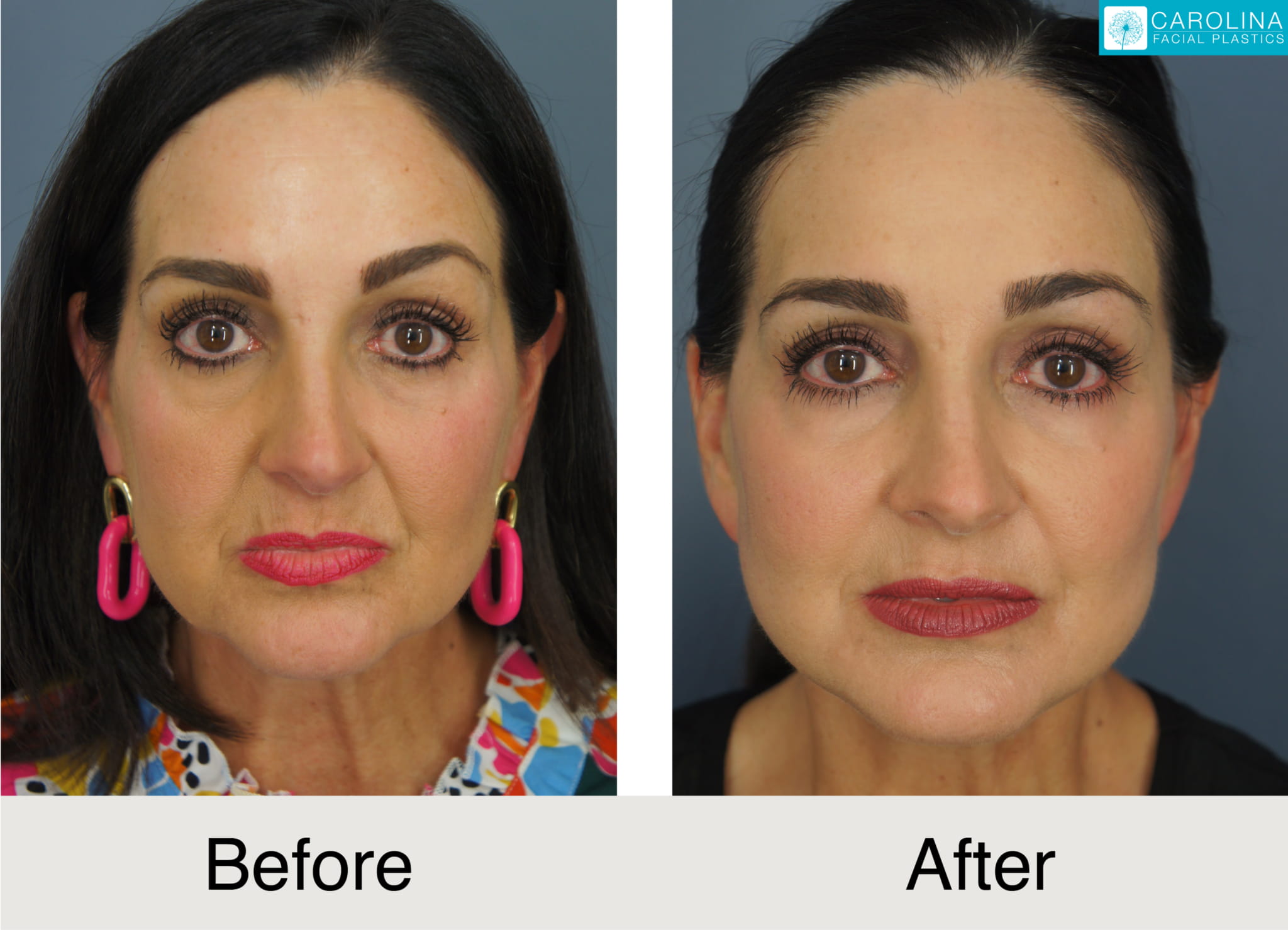 a female patient before and after a buccal fat removal procedure