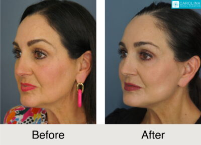 a female patient before and after a buccal fat removal procedure