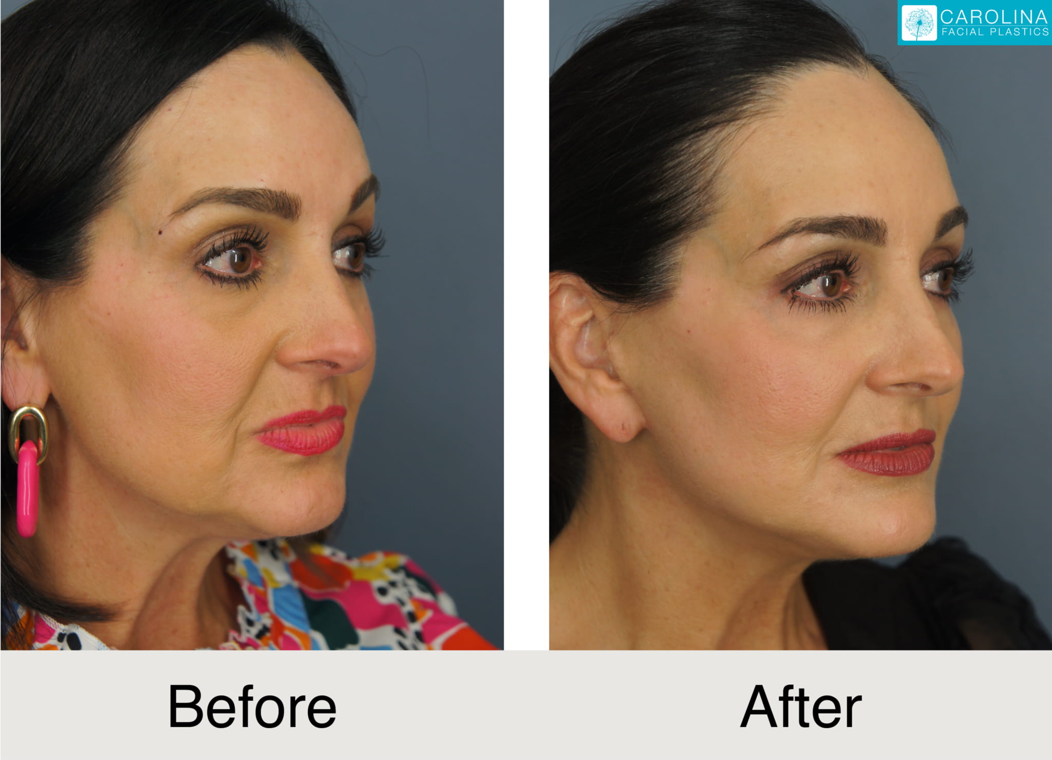 a female patient before and after a buccal fat removal procedure