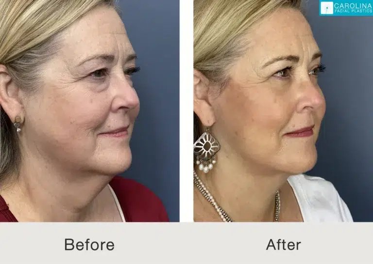 Real facelift results from a Charlotte woman - before and after