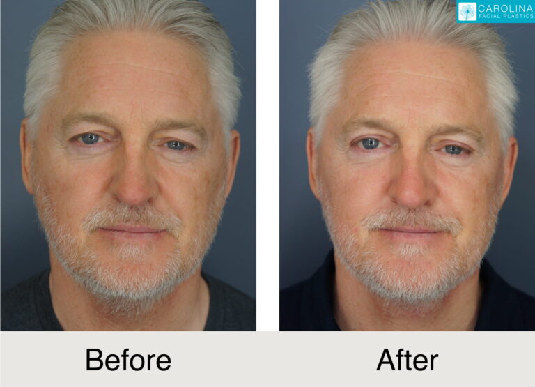 before and after photos of male patient upper eyelift