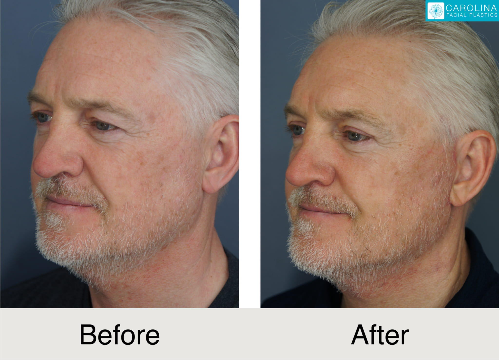 before and after photos of male patient upper eyelift