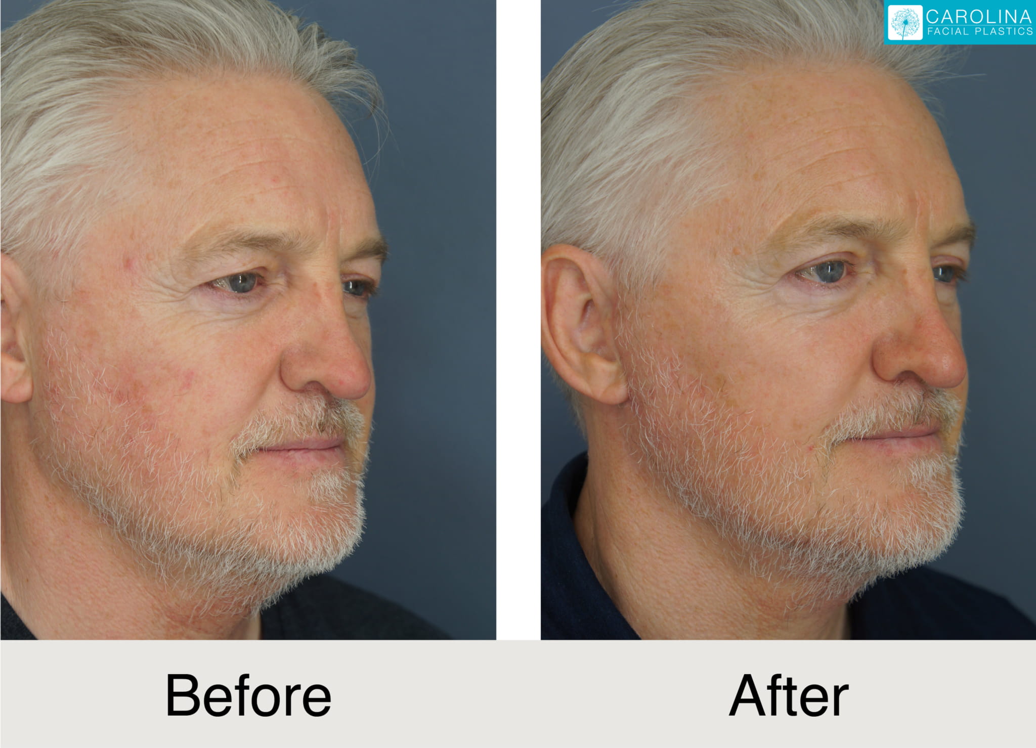 before and after photos of male patient upper eyelift