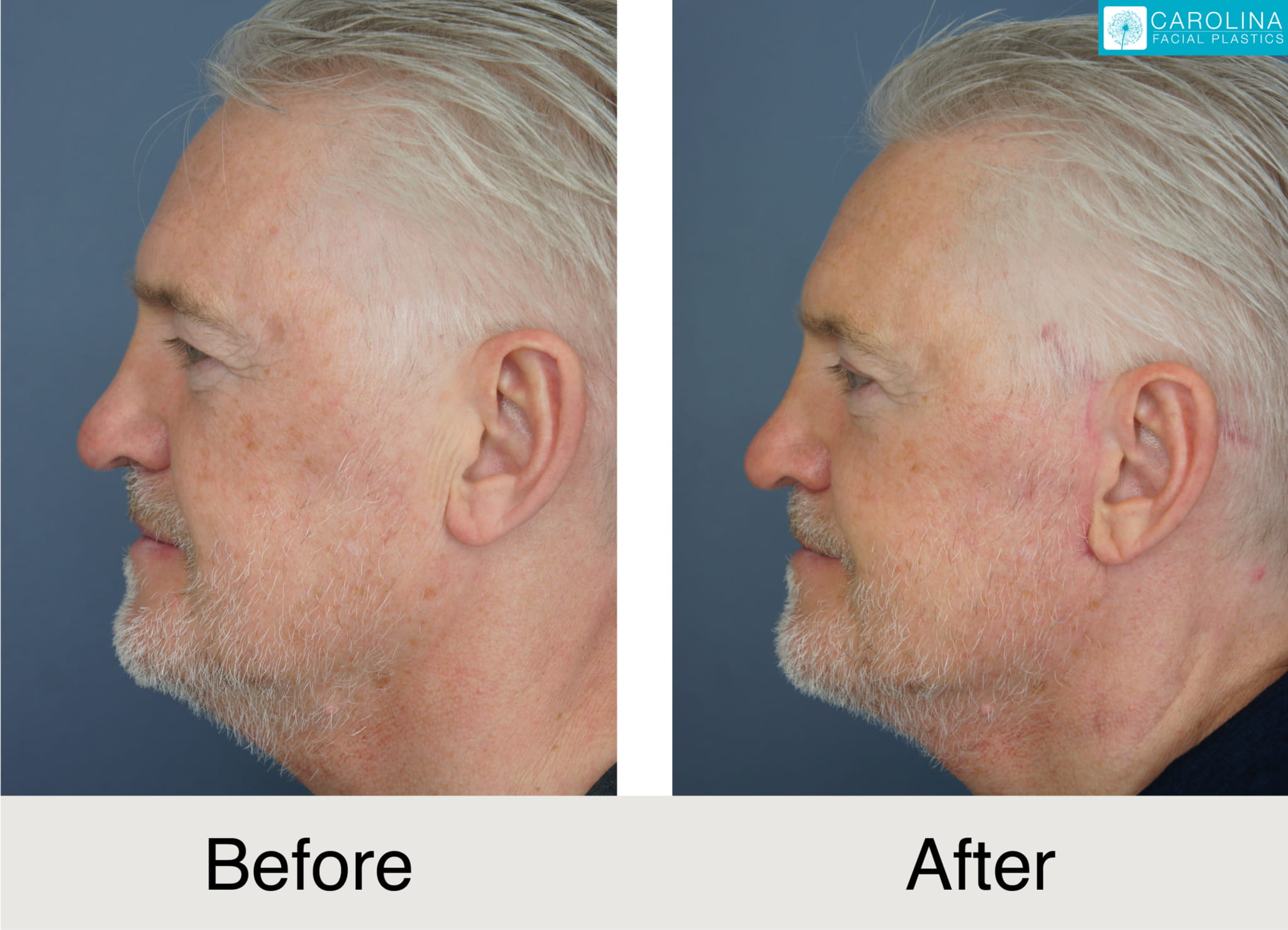 before and after photos of male patient upper eyelift