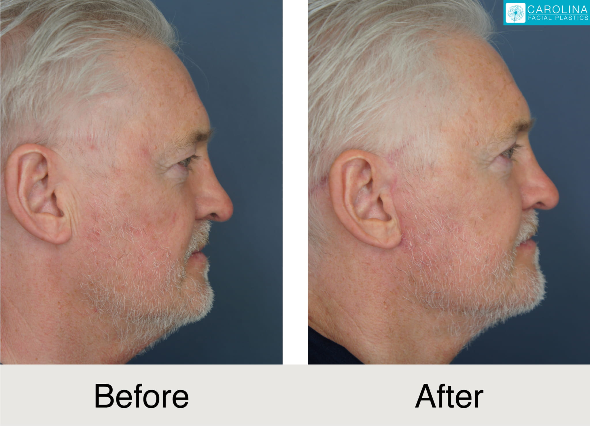 before and after photos of male patient upper eyelift