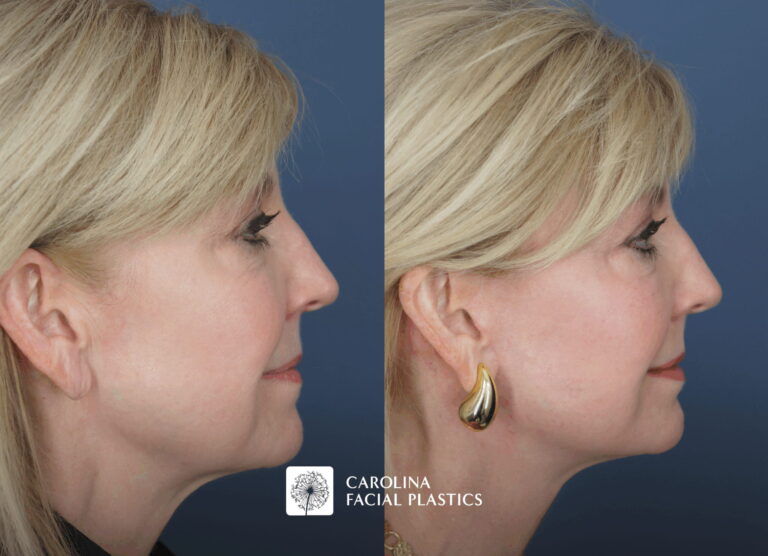 before and after mini facelift in charlotte