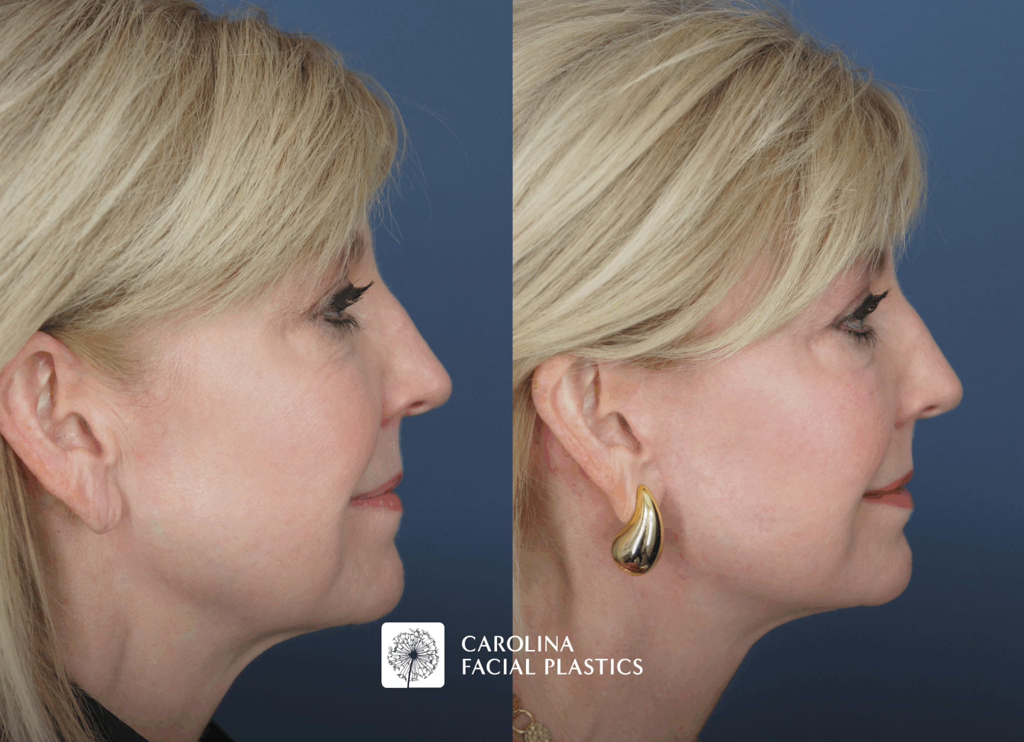 before and after mini facelift in charlotte