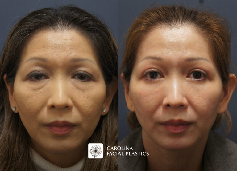 Female patient side by side comparison before and after eye treatment in Charlotte