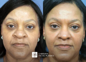 Side-by-side images showing a woman's face before and after a skincare procedure. The left image labeled "Before" shows her face with more prominent signs of aging and skin issues, while the right image labeled "After" depicts smoother, more youthful-looking skin. The woman has dark hair and is wearing a neutral expression in both images.