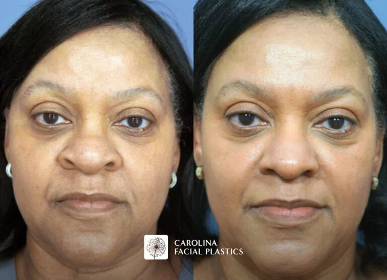 Side-by-side images showing a woman's face before and after a skincare procedure. The left image labeled "Before" shows her face with more prominent signs of aging and skin issues, while the right image labeled "After" depicts smoother, more youthful-looking skin. The woman has dark hair and is wearing a neutral expression in both images.