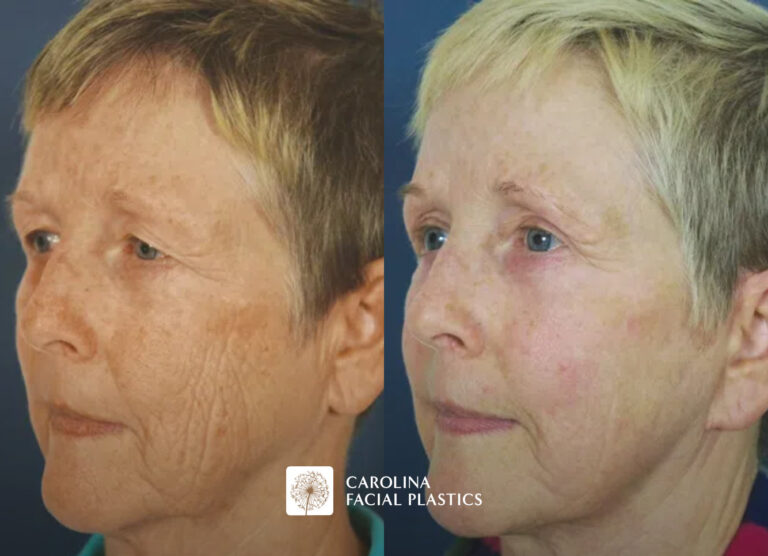 Side-by-side images showing the same older woman before and after a skin treatment. The "Before" image on the left shows her with more visible wrinkles and age spots on her face. The "After" image on the right shows her with smoother, more even-toned skin and fewer wrinkles. The text "Before" and "After" is written below their respective images.