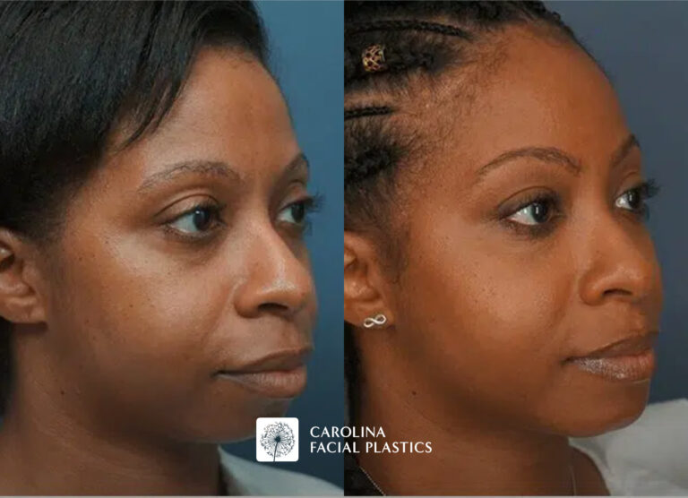 Face fat grafting in Charlotte, North Carolina