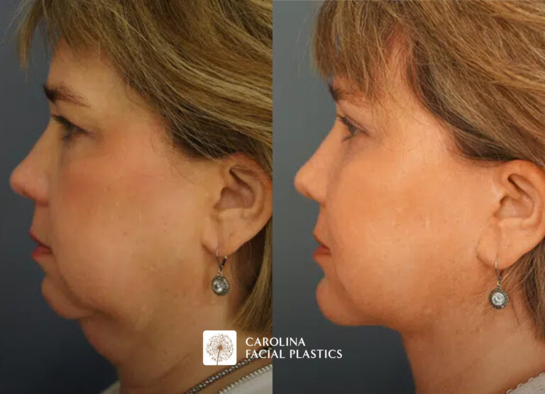 Female patient before and after eye treatment in Charlotte