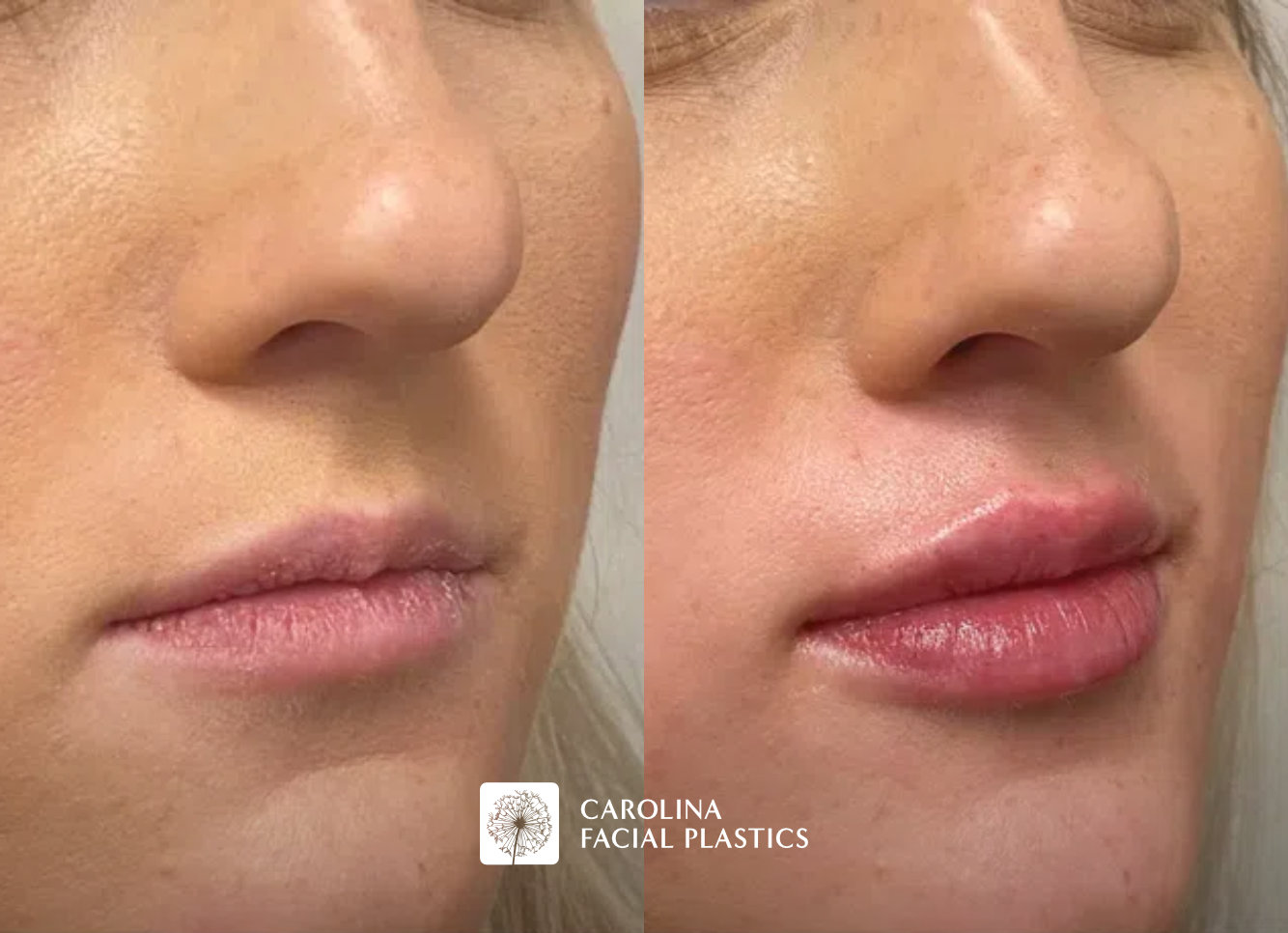 Close-up side-by-side comparison of a person's lips before and after a cosmetic procedure. The "before" image shows slimmer lips, while the "after" image shows fuller and more voluminous lips. Text below the images reads "Before" under the left image and "After" under the right image.