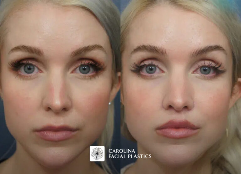 lip lift before and after