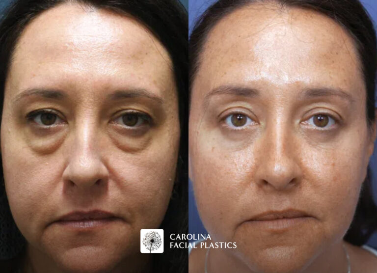 A side-by-side comparison image of a woman's face taken before and after a cosmetic procedure. The "Before" image on the left shows noticeable bags under her eyes and a generally uneven skin tone. The "After" image on the right displays a clearer and more even complexion, with significantly reduced under-eye bags.