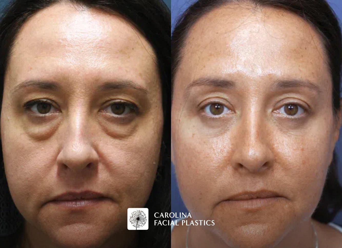 A side-by-side comparison image of a woman's face taken before and after a cosmetic procedure. The "Before" image on the left shows noticeable bags under her eyes and a generally uneven skin tone. The "After" image on the right displays a clearer and more even complexion, with significantly reduced under-eye bags.