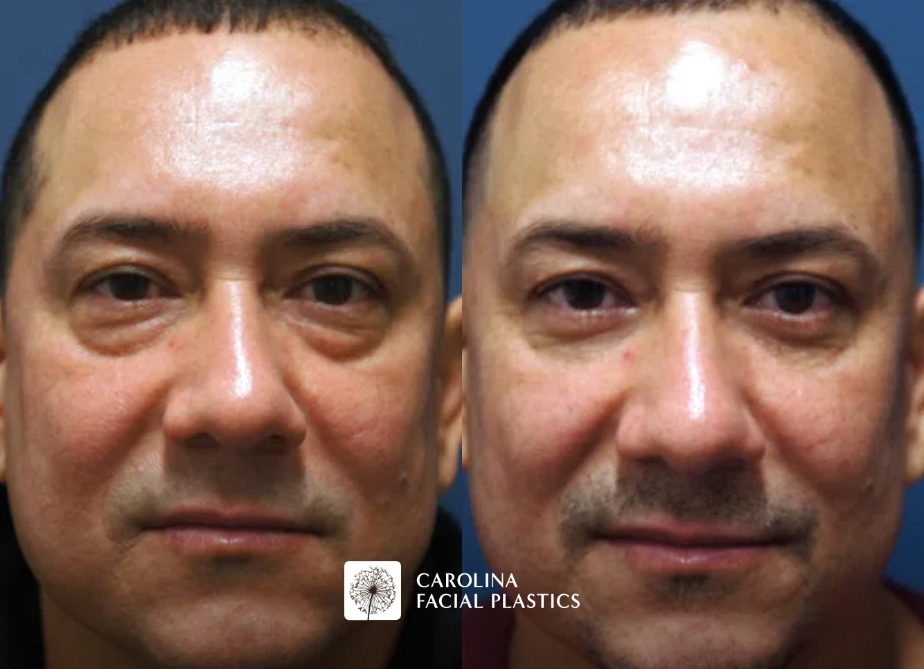 Side-by-side comparison of a man's face. The left image is labeled "Before" and shows him with noticeable undereye bags. The right image is labeled "After" and shows the same man with reduced undereye bags and a smoother complexion.