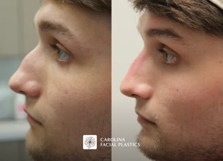 Side-by-side comparison of a young man before and after a cosmetic procedure. The left image shows his profile view labeled "Before," and the right image shows his profile view labeled "After," with noticeable changes to the shape and structure of his nose.