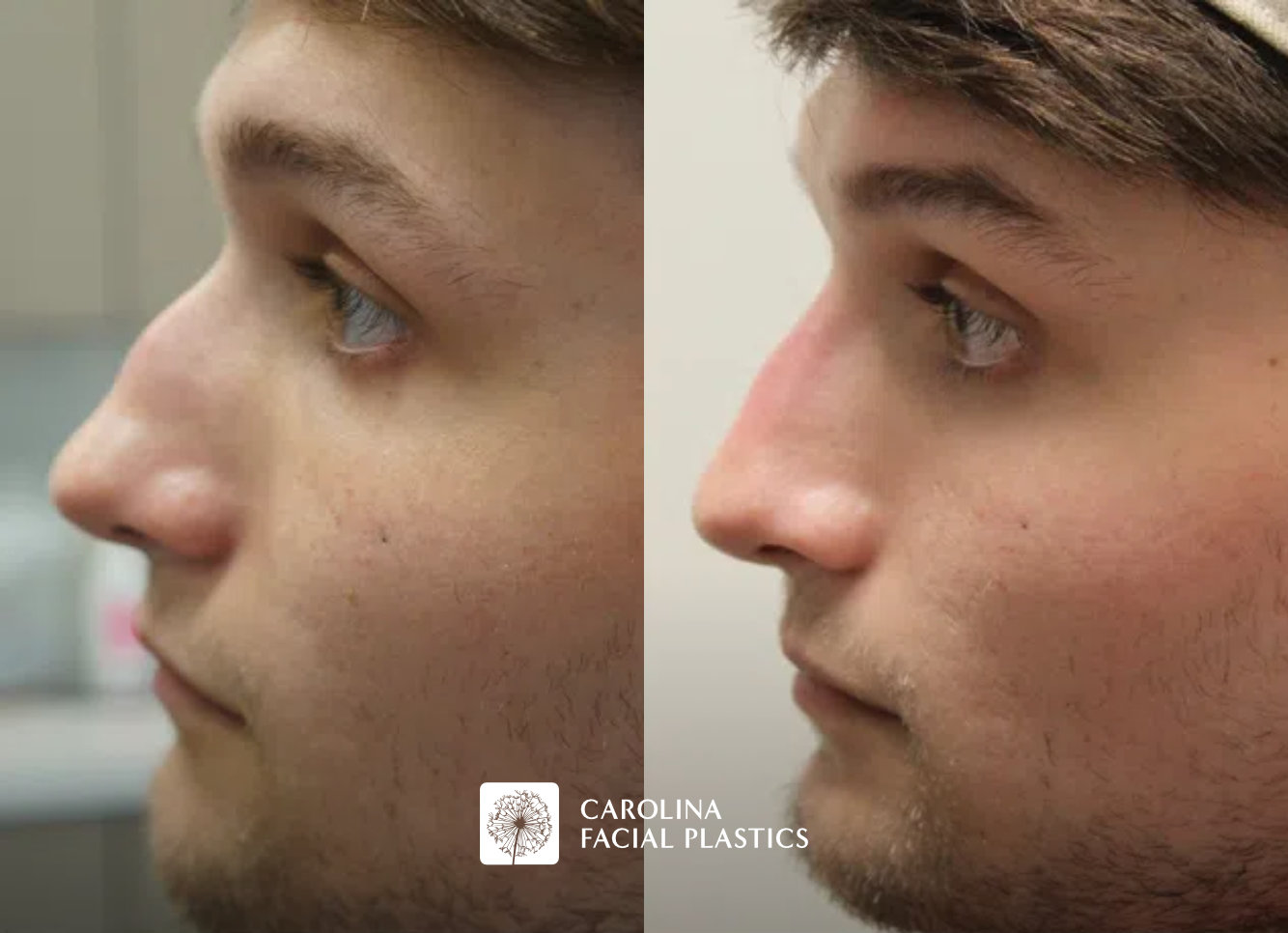 Side-by-side comparison of a young man before and after a cosmetic procedure. The left image shows his profile view labeled "Before," and the right image shows his profile view labeled "After," with noticeable changes to the shape and structure of his nose.