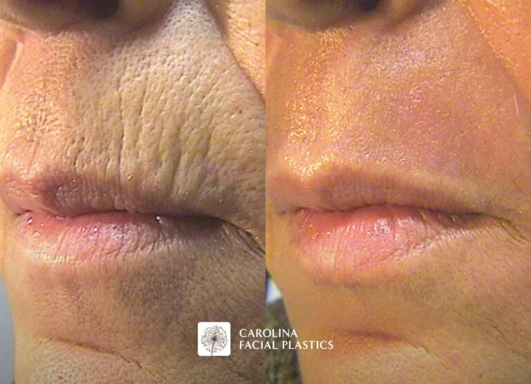co2 laser resurfacing before and after
