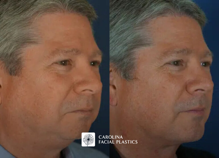 male chin implant results in charlotte, nc