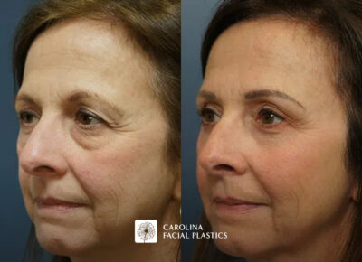 before and after blepharoplasty