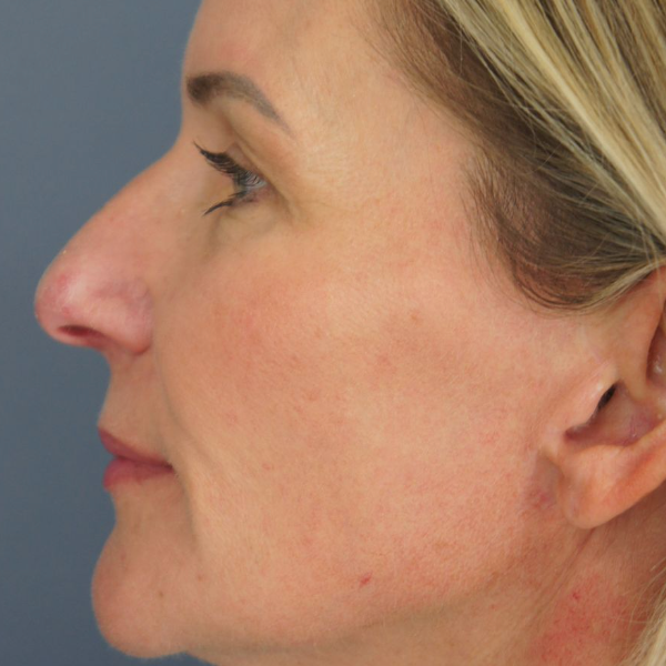 A close-up side profile of a middle-aged woman with light skin and blonde hair. The image shows the left side of her face, including her ear, cheek, eye, nose, and lips. The background is a plain blue-gray color.