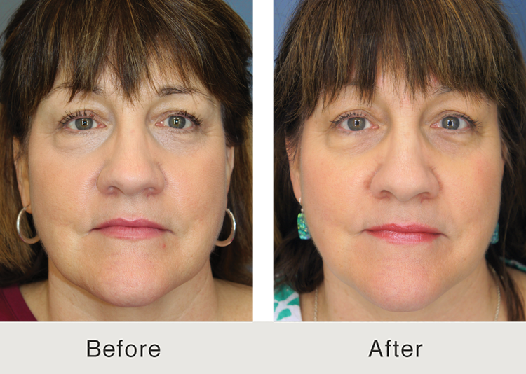 Side-by-side comparison of a woman before and after a cosmetic procedure. The left image shows the "Before" with the woman displaying minimal signs of aging, while the right image shows the "After" where her skin appears smoother and more youthful. The woman has medium-length brown hair and is wearing earrings in both images.
