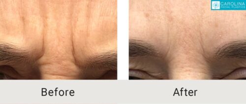 forehead wrinkles botox before and after 