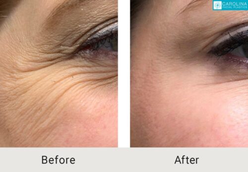 botox for crows feet before and after