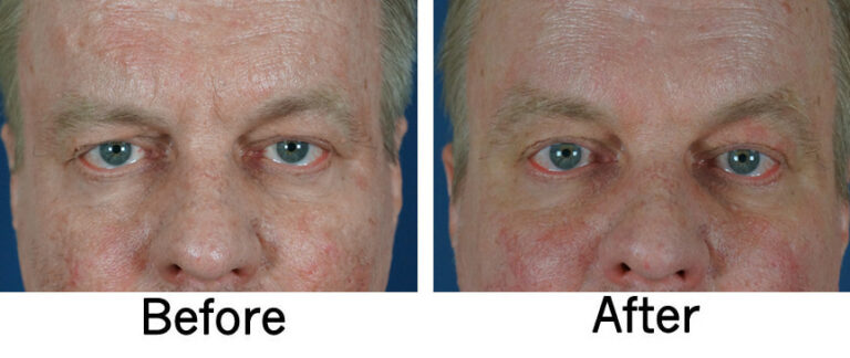 A side-by-side comparison image showing the face of an individual before and after a treatment. The image on the left is labeled "Before" and shows a face with visible redness and uneven skin texture. The image on the right is labeled "After" and shows a significant improvement in skin texture and redness.