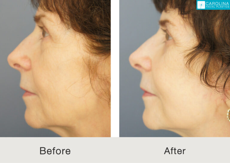 Mini Facelift, Lower Blepharoplasty, and Fat Grafting