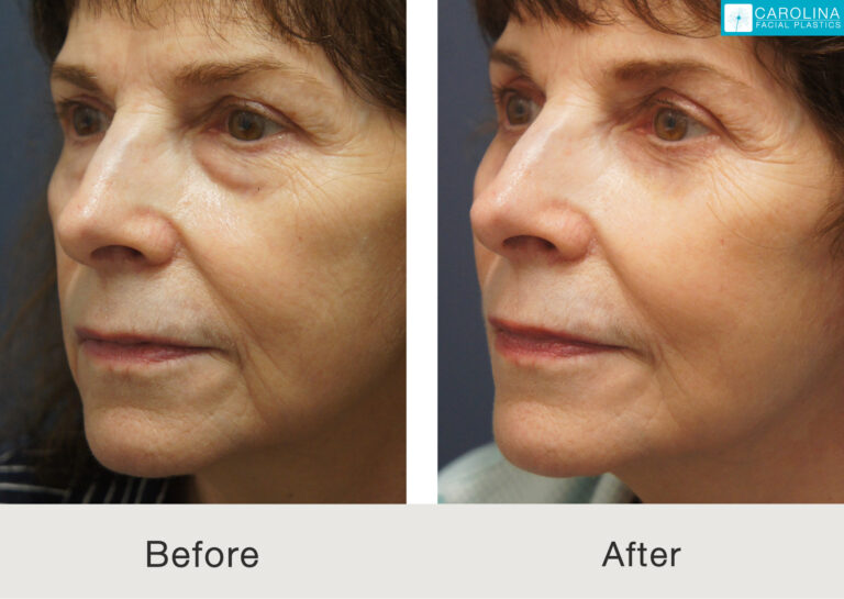 Mini Facelift, Lower Blepharoplasty, and Fat Grafting