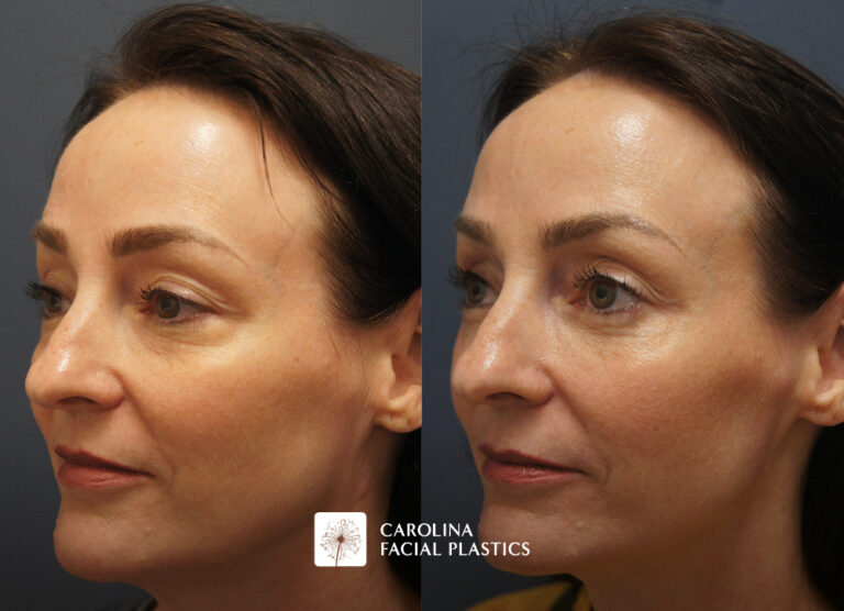 Kulbersh Lower Plepharoplasty Fat Grafting