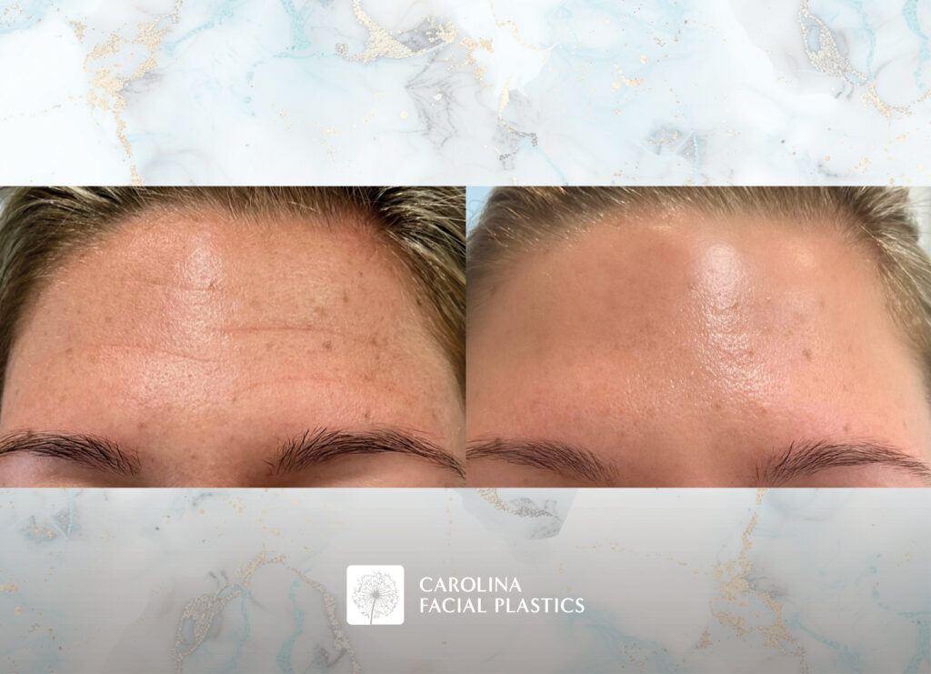before and after forehead wrinkles