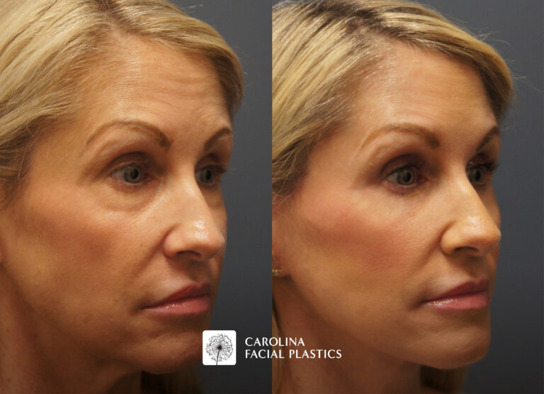 lower blepharoplasty before and after with other surgical procedures