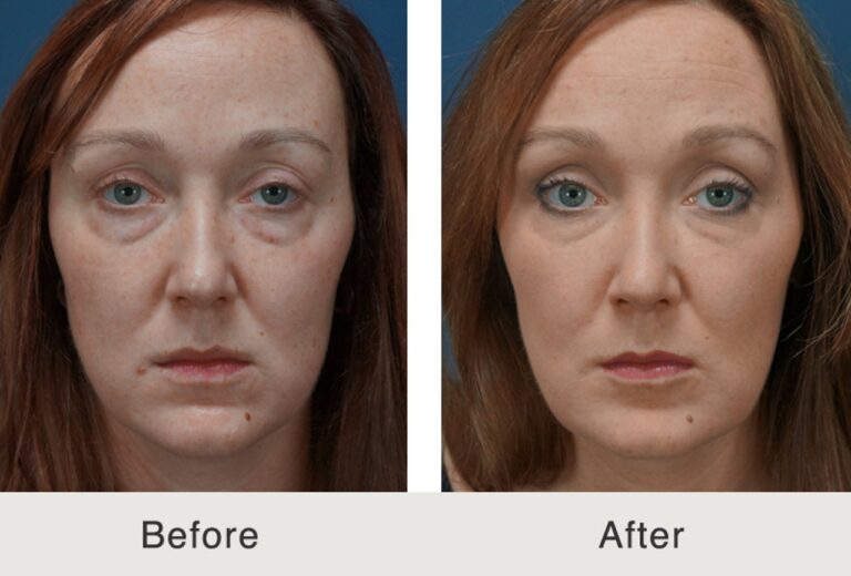 Dermal fillers before and after photo