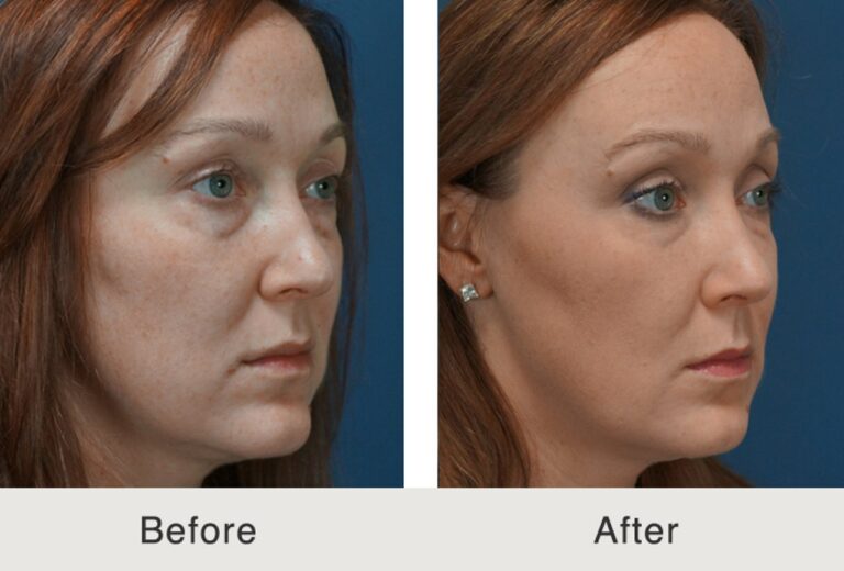 Dermal fillers before and after photo