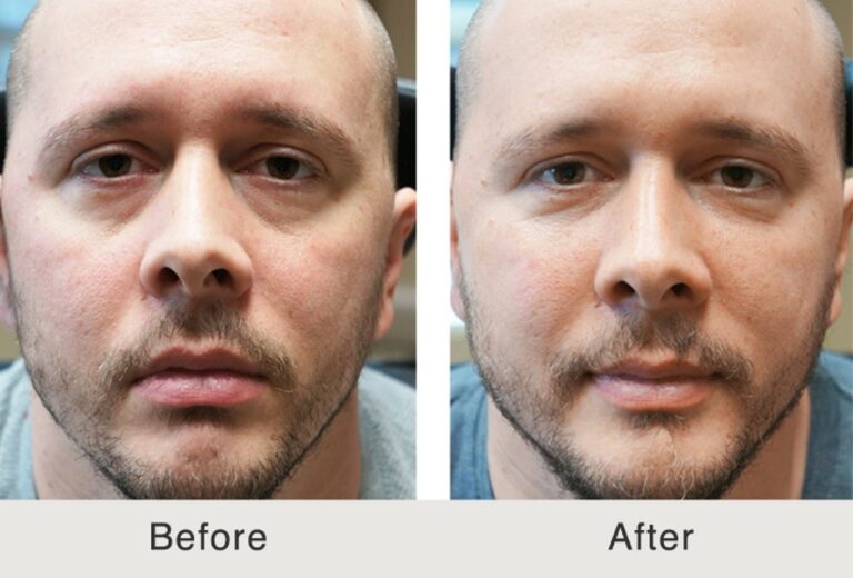 Dermal fillers before and after photo