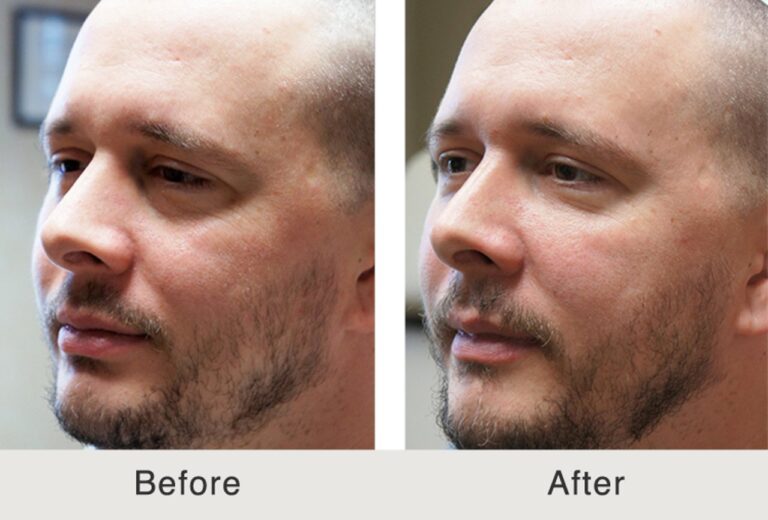 Dermal fillers before and after photo