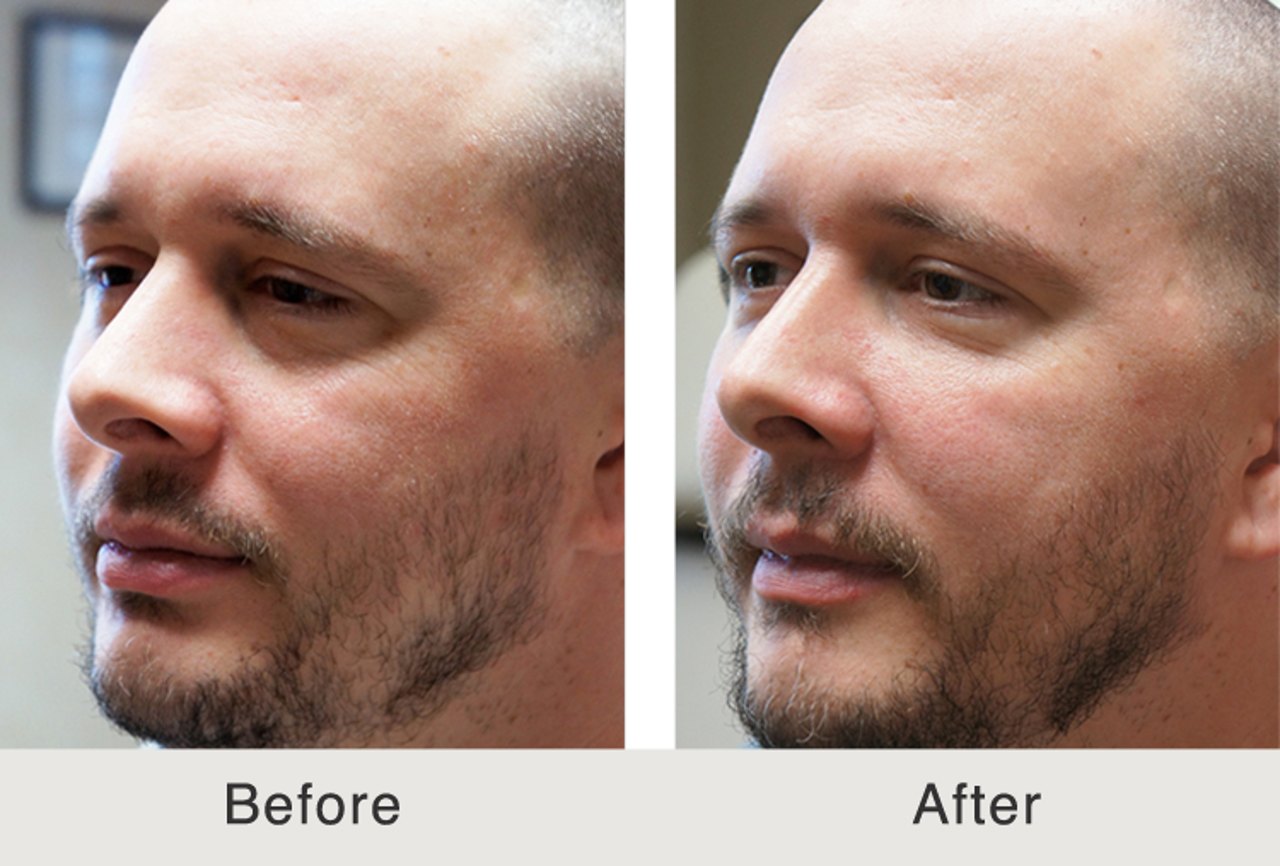Dermal fillers before and after photo