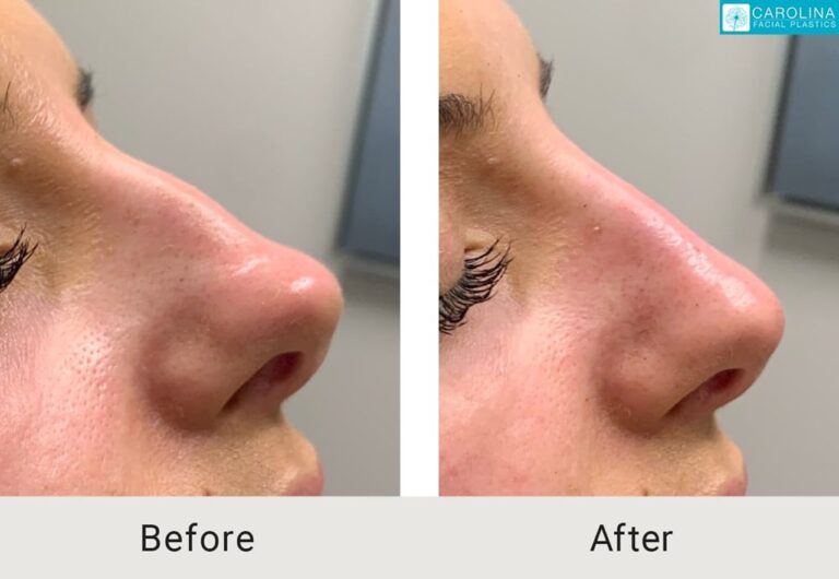 Dermal fillers before and after photo