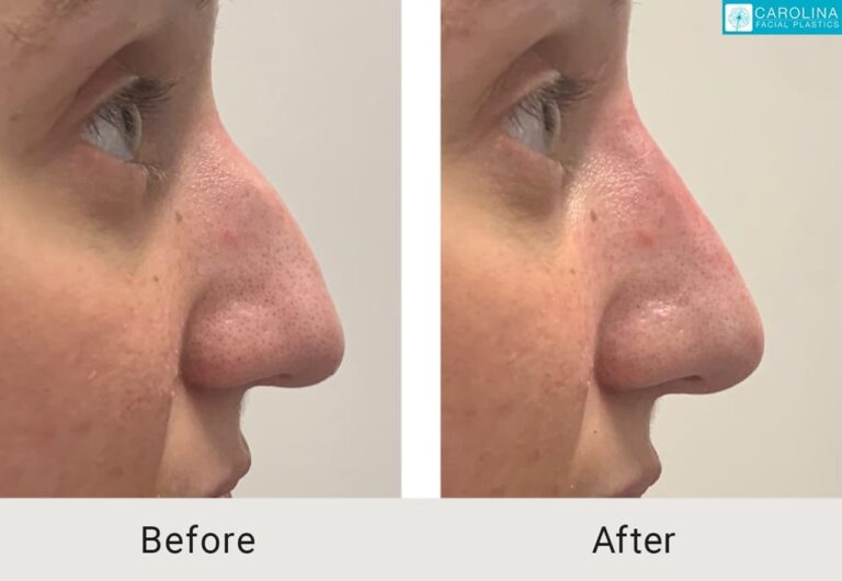 Dermal fillers before and after photo