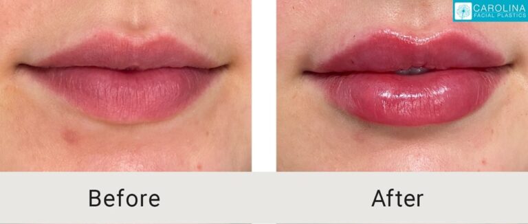 Dermal fillers before and after photo