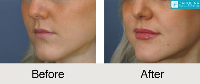 Dermal fillers before and after photo